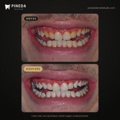 Limpieza de sarro y blanqueamiento - Pineda Dental Studio