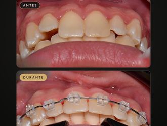 Ortodoncia antes y después - 881715