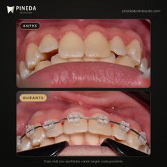 Ortodoncia estética - Pineda Dental Studio
