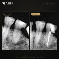 Endodoncia por infección - Pineda Dental Studio