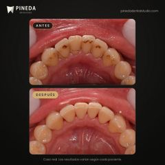 Limpieza de sarro y manchas - Pineda Dental Studio