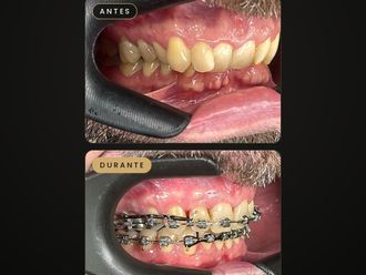 Ortodoncia antes y después - 881718