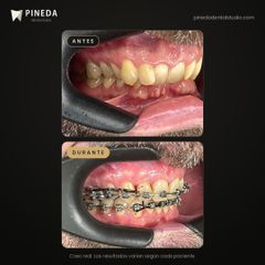 Ortodoncia con brackets metálicos - Pineda Dental Studio