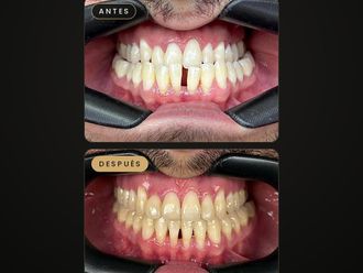 Ortodoncia antes y después - 881719