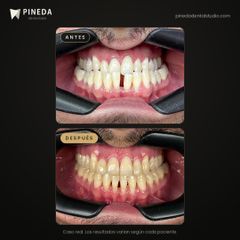 Cierre de diastema con ortodoncia - Pineda Dental Studio