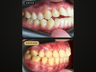 Ortodoncia antes y después - 881720