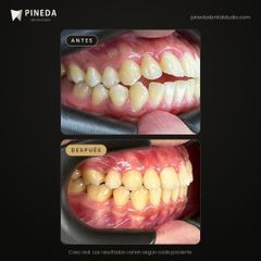 Mordida abierta corregida con ortodoncia - Pineda Dental Studio