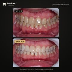 Limpieza profunda y blanqueamiento - Pineda Dental Studio