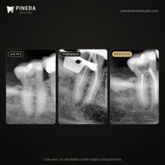 Endodoncia: antes, durante y después - Pineda Dental Studio