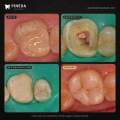 Endodoncia y reconstrucción de muela - Pineda Dental Studio