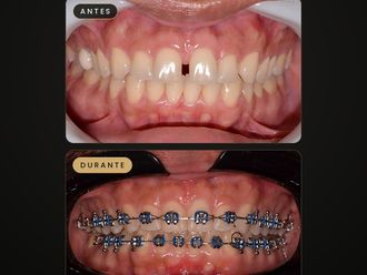 Ortodoncia antes y después - 881724