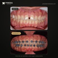 Ortodoncia con brackets y cierre de diastema - Pineda Dental Studio