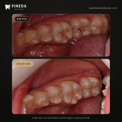 Restauraciones de resina en muelas - Pineda Dental Studio