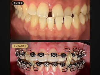 Ortodoncia antes y después - 881726