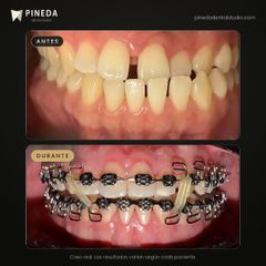 Ortodoncia con brackets metálicos - Pineda Dental Studio