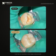 Incrustación estética en una muela - Pineda Dental Studio