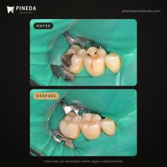 Cambio de amalgama por resina - Pineda Dental Studio