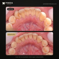 Limpieza y eliminación de sarro - Pineda Dental Studio