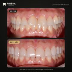 Carillas de composite sin desgaste - Pineda Dental Studio