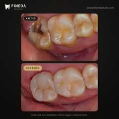 Incrustación de composite en una muela - Pineda Dental Studio