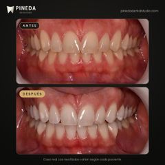 Blanqueamiento dental con luz LED - Pineda Dental Studio
