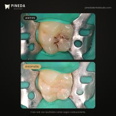 Caries tratada con composite - Pineda Dental Studio