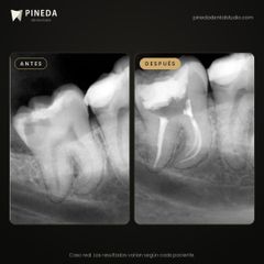 Endodoncia en raíces curvas - Pineda Dental Studio