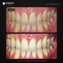 Cambio de sonrisa - Pineda Dental Studio
