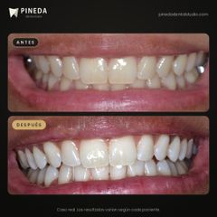 Sonrisa renovada - Pineda Dental Studio