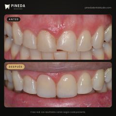 Carillas de resina - Pineda Dental Studio