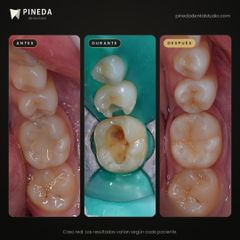 Restauraciones en molar y premolar - Pineda Dental Studio