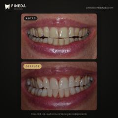 Blanqueamiento dental combinado - Pineda Dental Studio