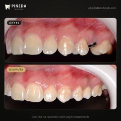 Implante con corona - Pineda Dental Studio