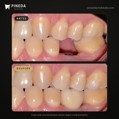 Implante con corona en un molar - Pineda Dental Studio