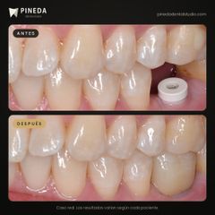 Implante con corona - Pineda Dental Studio