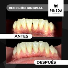 Injerto de encía - Pineda Dental Studio
