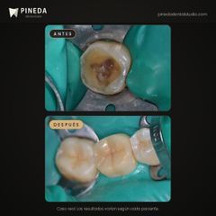 Incrustación de resina en un molar - Pineda Dental Studio