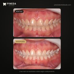 Limpieza y blanqueamiento dental - Pineda Dental Studio