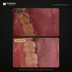 Resinas por caries en molares - Pineda Dental Studio