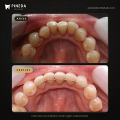 Ortodoncia: contención fija - Pineda Dental Studio