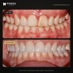Carilla de composite en diente fracturado - Pineda Dental Studio