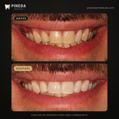 Blanqueamiento dental - Pineda Dental Studio