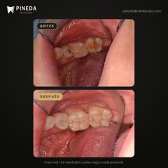 Resinas en muelas inferiores - Pineda Dental Studio
