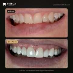 Carillas en el maxilar superior - Pineda Dental Studio