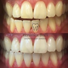 Blanqueamiento dental - Dra. Verónica Boffi