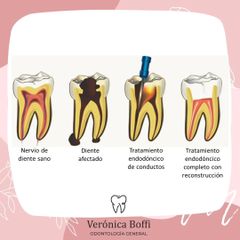 Endodoncia - Dra. Verónica Boffi