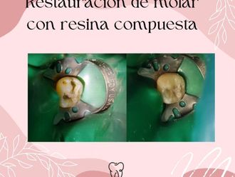 Endodoncia antes y después - 871505