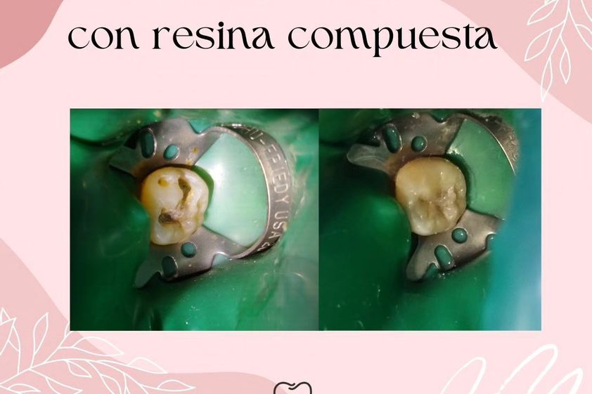 Endodoncia antes y después - 871505