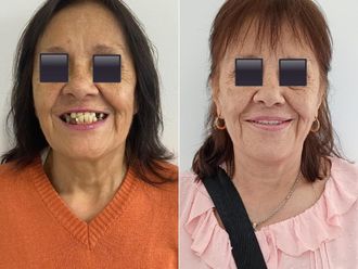 Implantes dentales antes y después - 871826