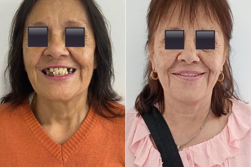 Implantes dentales antes y después - 871826